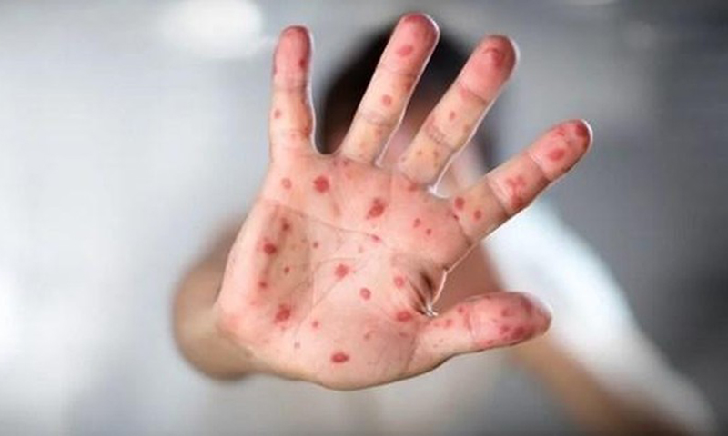 Một bệnh nhân mắc bệnh đậu mùa khỉjpg